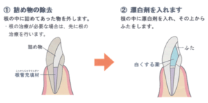 ウォーキングブリーチ